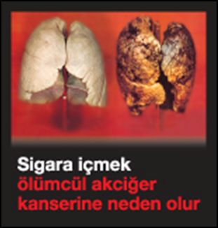 Turkey 2009 Health Effects lung - diseased organ, lung cancer, gross